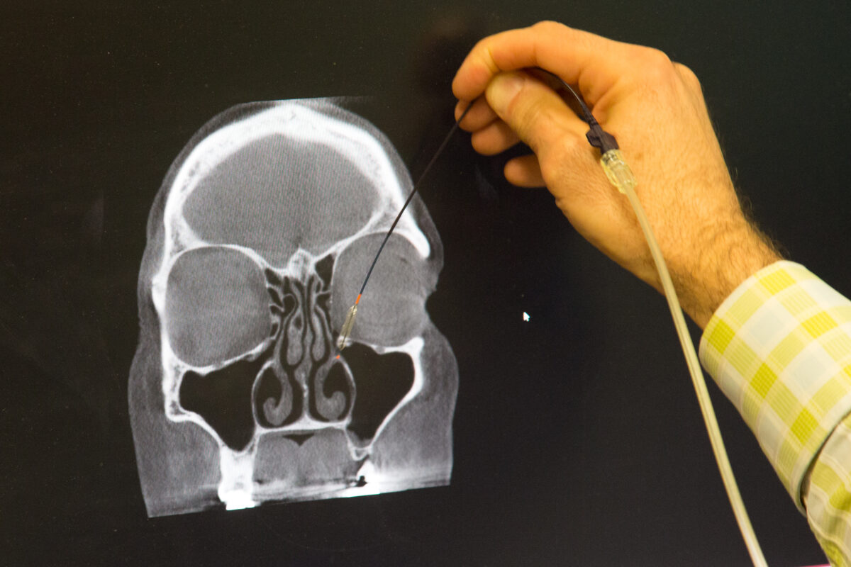 Nose balloons? Ogden doctor explains simple sinus procedure News